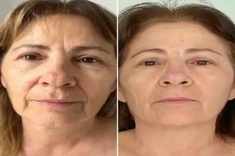 HIFU vs. Traditional Facelift: Which One’s Right for You? HIFU vs. Traditional Facelift