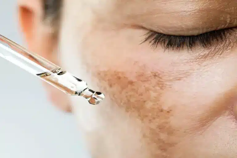 How to Tell If It’s Pigmentation or Something More Serious Pigmentation